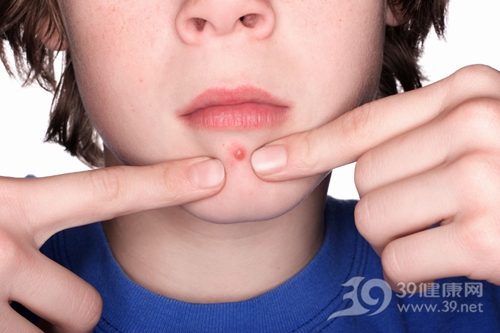 孩子 男 皮肤 痘痘 青春痘_668307_xl